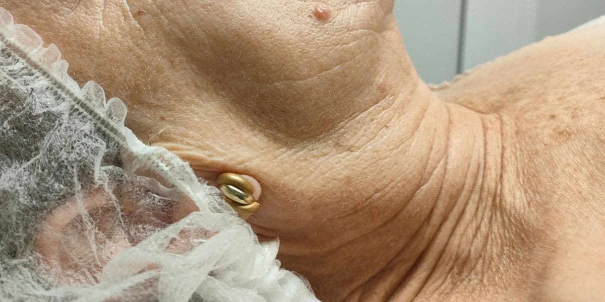 Zona del cuello de una paciente antes de recibir el tratamiento de Láser Azul en el Centro de Estética Jennifer Serrano