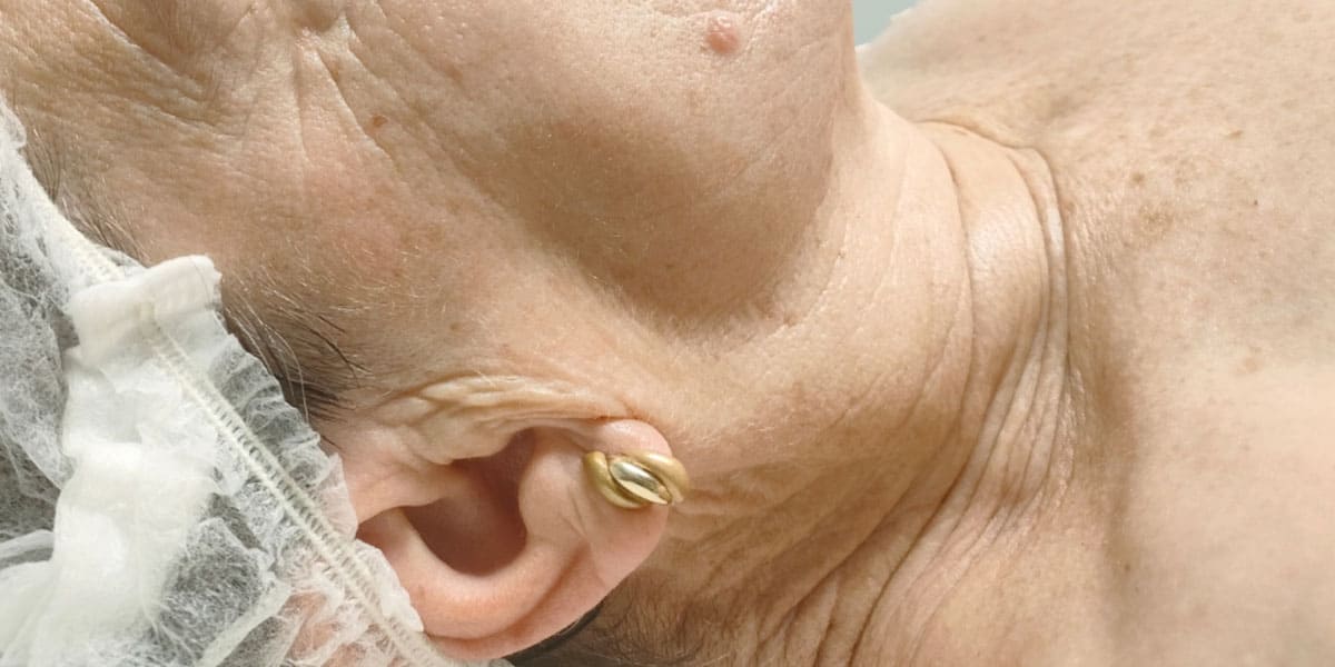 Zona del cuello de una paciente después de recibir el tratamiento de Láser Azul en el Centro de Estética Jennifer Serrano