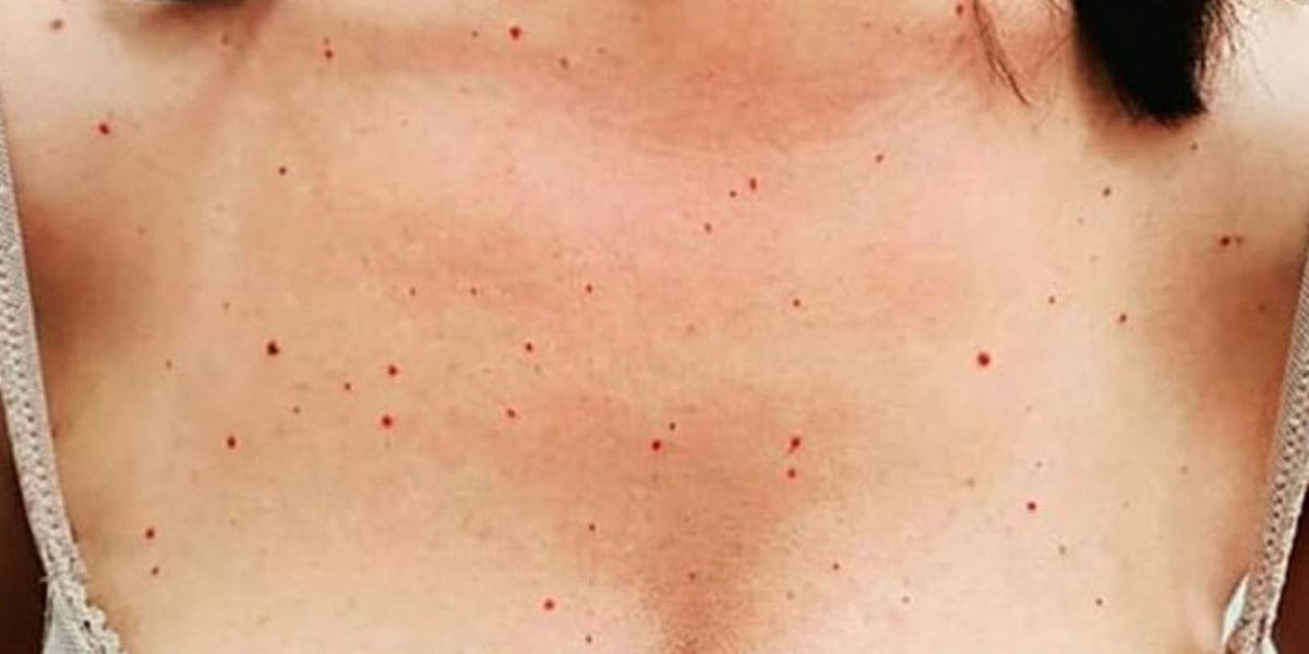 Zona del pecho de una paciente antes de recibir el tratamiento de Láser Azul en el Centro de Estética Jennifer Serrano