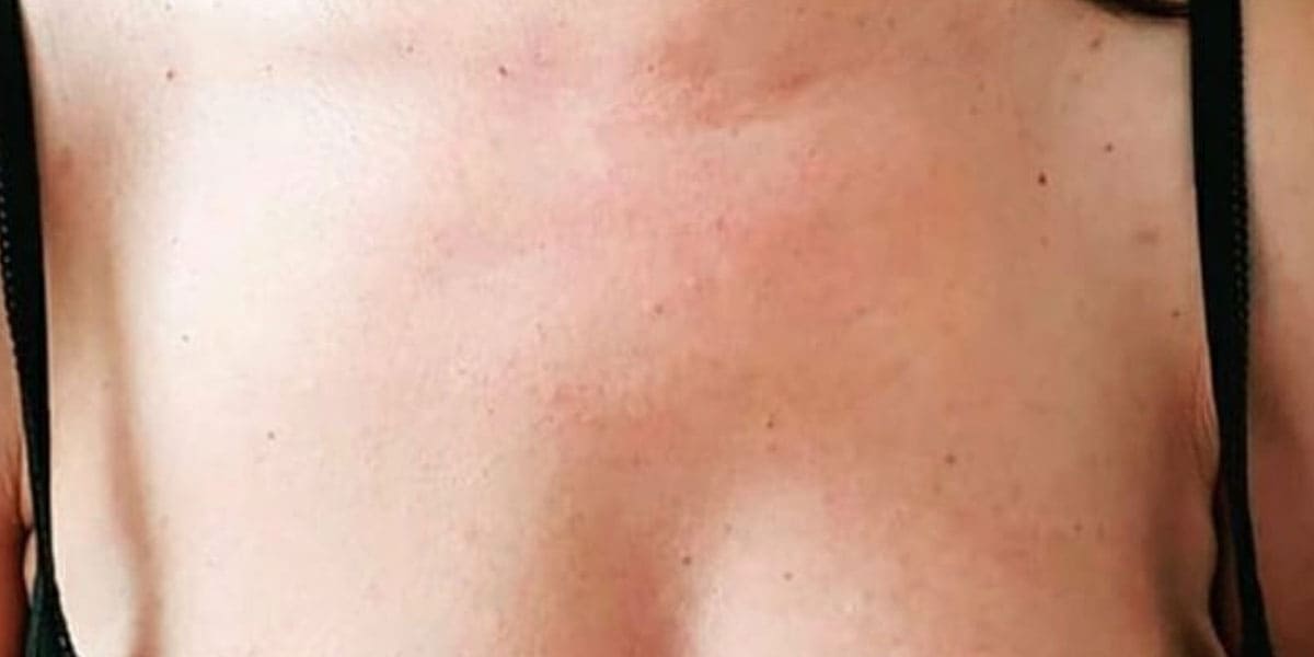Zona del pecho de una paciente después de recibir el tratamiento de Láser Azul en el Centro de Estética Jennifer Serrano